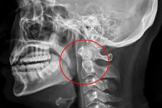 Kórházba került, mert a száját és orrát befogva tüsszentett: ezért veszélyes ez a módszer