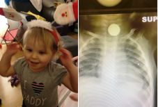 Hónapokig nem vették észre, hogy az egyéves kislány torkán akadt egy elem