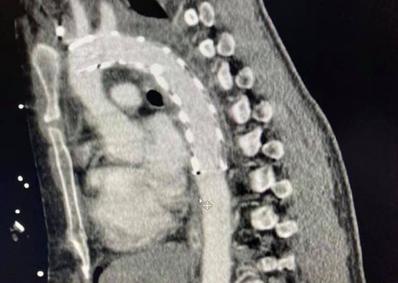 Az országban először ültettek mellkasi aortába endoprotézist Marosvásárhelyen