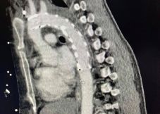 Az országban először ültettek mellkasi aortába endoprotézist Marosvásárhelyen