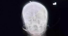 Rendőrök keresik a kuruzslót, aki szöget vert egy várandós nő fejébe