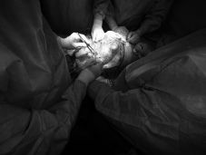 Tizenkét kilogrammos daganatot távolítottak el egy betegből Marosvásárhelyen