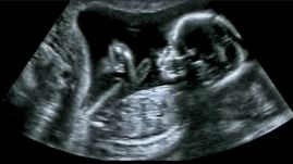 Nem a saját magzatát ültették be egy lombikbébiprogramban részt vevő nőnek Izraelben