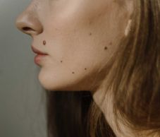 Egy ártalmatlannak tűnő anyajegy is veszélyes lehet