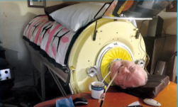 Meghalt a férfi, aki 70 évig élt vastüdőben: a gyermekbénulás következtében kényszerült rá az eszközre