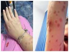 Egy diák több tucat poloskacsípéssel került kórházba: számonkérik Marcel Ciolacut a kollégiumban uralkodó állapotok miatt