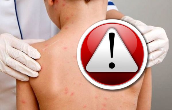 Továbbra is tarol a kanyaró – egy 34 éves HIV-fertőzött nő belehalt