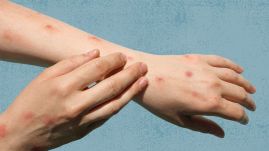 Uniós járványvédelmi központ: növekedni fog a majomhimlős fertőzöttek száma az EU-ban