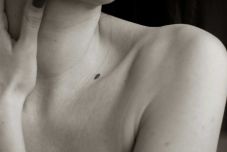 Az anyajegyrák az egyik legveszélyesebb daganattípus – Bőrgyógyászt kérdeztünk