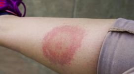 Rejtélyes rovarok Kolozsváron – Brutális csípések, pánik a sürgősségin