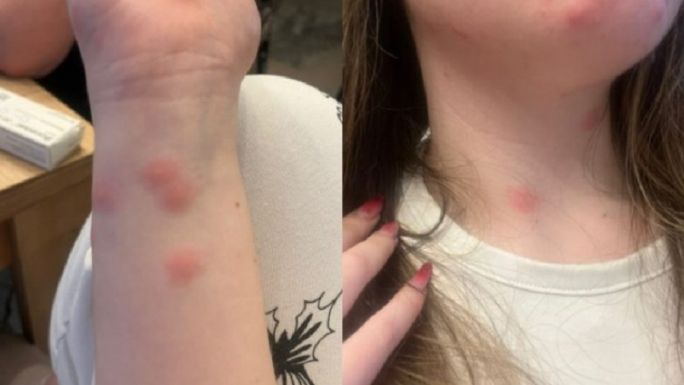 Fiatal nő került kórházba, miután poloskák csípték össze a vonaton