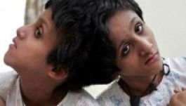 Sziámi ikrek: nem voltak “eléggé” mozgáskorlátozottak