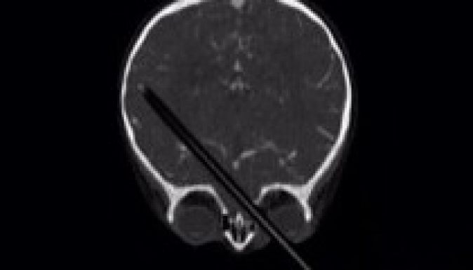 Ceruzával a fejében élt évekig egy afgán fiatalember