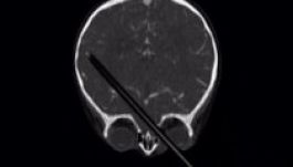 Ceruzával a fejében élt évekig egy afgán fiatalember