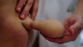 Tíz centis farokkal született egy kínai kisbaba