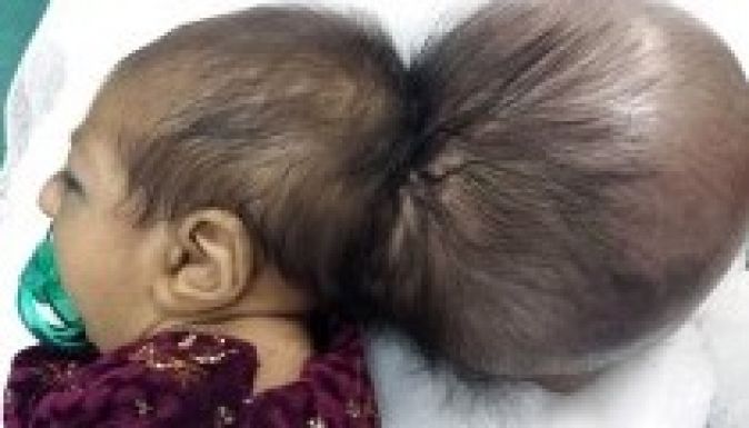 Leműtötték a kétfejű kislány második koponyáját