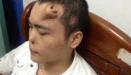 Orrot növesztettek egy kínai férfi homlokára (VIDEÓ)