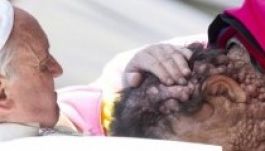 Ritka bőrbetegségtől szenvedő férfit ölelt magához Ferenc pápa