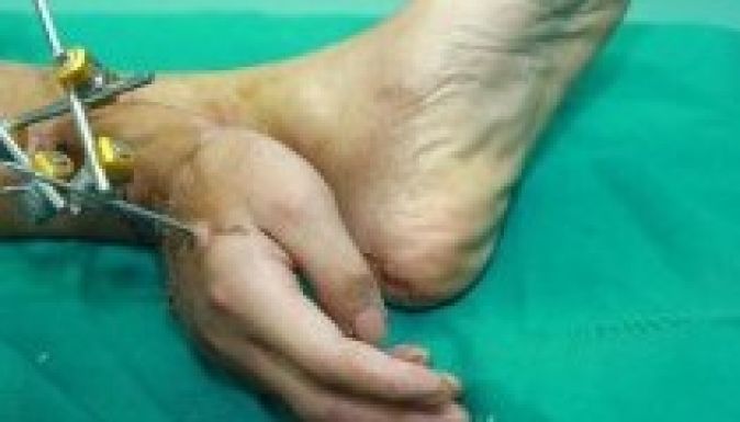 Egy hónapig a bokáján viselte levágott kezét egy kínai férfi