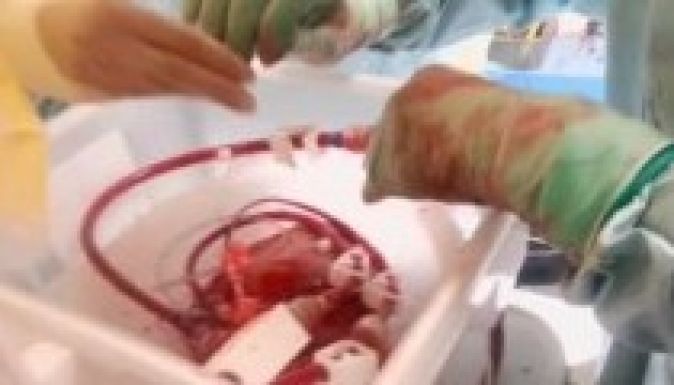 Két év szünet után újraindul a szívátültetés Marosvásárhelyen