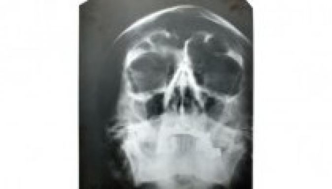 Elárverezik Hitler koponyájának röntgenfelvételét