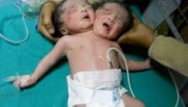 Kétfejű egészséges gyerek született Indiában