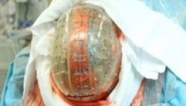 3D nyomtatott koponya mentett életet