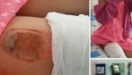 Felrobbant az okostelefon a kislány zsebében