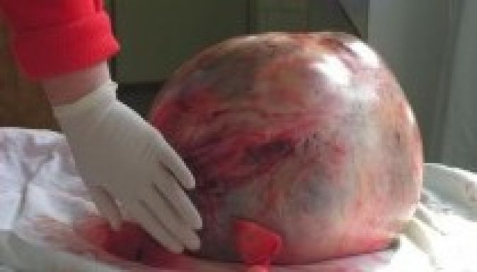 Negyedmázsás petefészek-daganattól szabadítottak meg egy nőt