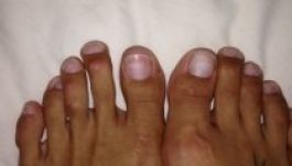 Egyre több brit nő rövidíti le a lábujjait