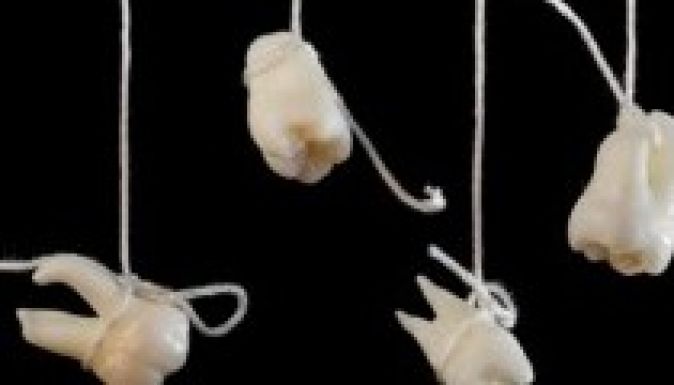 Egy indiai kamasznak 232 fogát kellett kihúzni