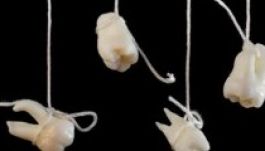 Egy indiai kamasznak 232 fogát kellett kihúzni