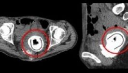 Tíz évig hordott magában egy szexjátékot egy nő