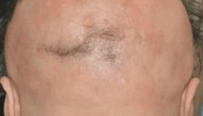 Búcsút inthetünk a kopaszodásnak