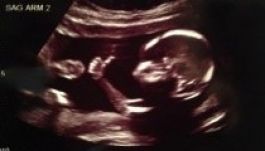 Lájkolta a magzat az ultrahangfelvételt