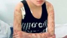 Húsevő drog miatt amputálták egy magyar lány karját