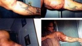 Felrobbant a karja a túl sok szteroidtól