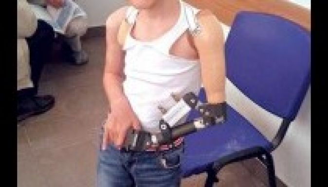 Magyarországon kapott műkart egy román kisfiú