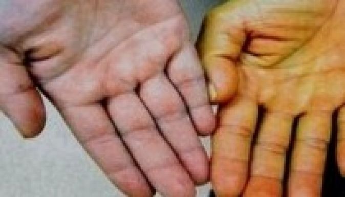 Kíméletlenül terjed a mocskos kezek betegsége Háromszéken