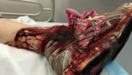 Koala harapott meg egy nőt, 12 öltéssel varrták össze a sebét