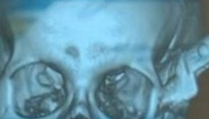 Száz kilométert motorozott késsel a koponyájában