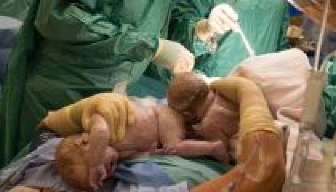 Császármetszés során az anya maga segíthette ki hasából az ikreit