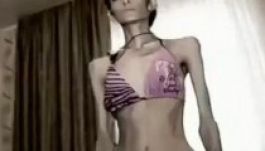 Mindössze 21 kg-os testsúlyú egy 23 éves nő (VIDEÓ)