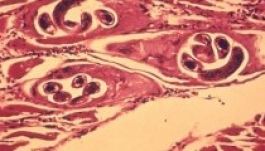 Kórházban kezelnek több személyt trichinellózis miatt