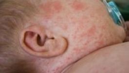 Boszniában is terjed a kanyaró az oltásellenesség miatt