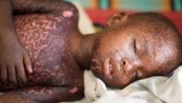 Új kór csaphat le az ebola után