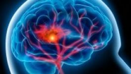 Amerikai tanulmány: stroke-hoz vezethet a légszennyezettség