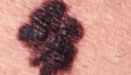 Nagyon korán felfedezhető a bőrrák egy új módszerrel