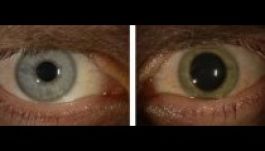 Egy gyógyult ebolás beteg szemében még megmaradt a vírus