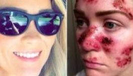 Megrázó képeken mutatja be egy anyuka a szolárium káros hatásait